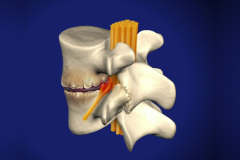 Spondylosis-1